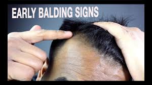 Each person has about 100 000 hairs and it's normal to lose 50 to 100 hairs a day. How To Know If You Re Going Bald Signs Of Male Pattern Baldness Youtube