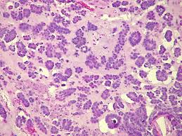 That means that of all people who have bladder cancer, 77 of every 100 are living five years after diagnosis. Carcinoma Definition Types Explanation And Quiz Biology Dictionary