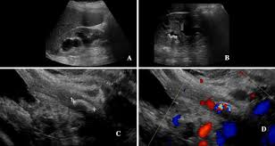 Detection Of Distal Ureteral Stones In Pregnancy Using Transvaginal Ultrasound Springerlink
