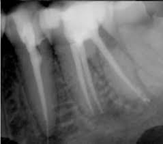 اﻟﺗﻘﻳﻳم اﻟﺳرﻳري واﻟﺷﻌﺎﻋﻲ ﻟﻣﺎدة Theracal LC ﻓﻲ اﻟﺗﻐطﻳﺔ اﻟﻠﺑﻳ