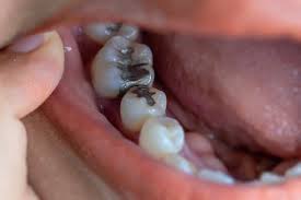 Maybe you would like to learn more about one of these? Serba Serbi Tambal Gigi Prosedur Jenis Dan Biaya Orami
