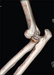 Image result for Elbow Dislocation