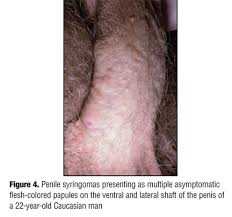 We know the ins and outs of pubic hair removal. Penile Syringoma Reports And Review Of Patients With Syringoma Located On The Penis Jcad The Journal Of Clinical And Aesthetic Dermatology