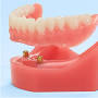 Dental Dentures from www.aspendental.com
