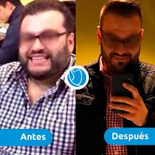 Gastric balloon in Tijuana