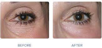 Laser Skin Resurfacing Under Eyes Google Search Under Eye Wrinkles Eye Wrinkle Drooping Eyelids