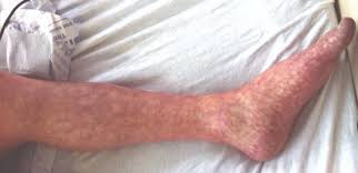 Brown or other venous stasis lesions on the skin come fro. Livedo Reticularis Wikipedia