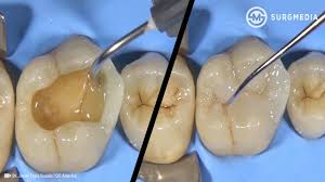 How long does it take by train from london to manchester? Step By Step Dental Filling Cavity Filling Tooth Filling Cusp Build Up Of A Molar Youtube