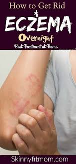 13 Home Remedies To Get Rid Of Eczema That Finally Took Away Our Eczema I Have Tried Everything For O Home Remedies For Eczema Psoriasis Cure Eczema Remedies