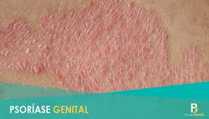 Caracterizada pelo aparecimento de placas eritrodescamativas nas regiões das dobras flexurais, cuja descamação é mascarada pela sudorese presente nessas regiões. Psoriase Brasil Psoriase Genital Um Dos Tipos Mais Facebook