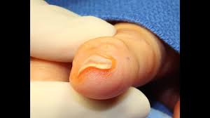 Watching these videos is almost as good as doing it yourself. Live Surgery Ganglion Cyst Distal Interphalangeal Joint Finger Youtube