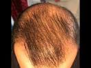 Rogaine Minoxidil Before After