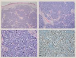 Factors involved in the development of mcc include the merkel cell polyomavirus (mcpyv or mcv), a wea. Merkel Cell Carcinoma A Review And Update On Current Concepts Diagnostic Histopathology