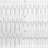 Its contribution to the ecg and to normal and abnormal 37.weber dos santos r., kosch o., steinhoff u. 1