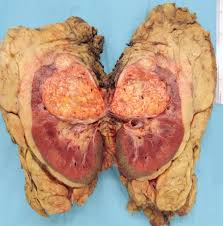 Buah pinggang adalah organ penapis darah kita. 5 Tip Menjaga Buah Pinggang