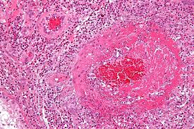 Educational image placeholder: heart and lung involvement in eosinophilic granulomatosis with polyangiitis