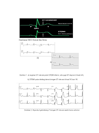 John's wort dianggap dapat mengobati depresi. Gambaran Ekg Normal Dan Stemi