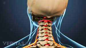 What Is Cervical Radiculopathy Radiculopathy Cervical Radiculopathy Neck Cracking