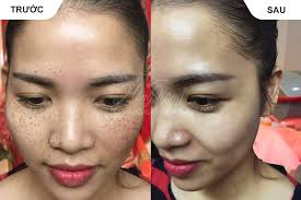 Kết quả hình ảnh cho HÌNH ẢNH TRỊ NÁM