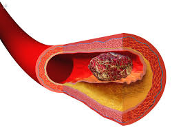 La trombosis es trombosis causas y tratamiento trastorno vascular que se presenta cuando se desarrolla un trombo, o masa trombosis causas y tratamiento sangre coagulada. La Trombosis Causas Sintomas Y Consecuencias Hematologo En Los Cabos