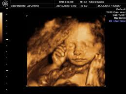 Pin Em Ultrasound Scan Images