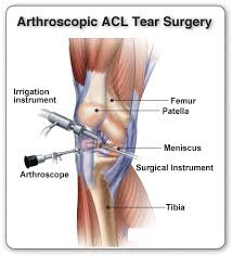 Get Best Acl Reconstruction By Arthroscopic Surgery In Chennai India By An Experienced Orthopedic Surgeon Meniscus Surgery Knee Surgery Recovery Acl Surgery