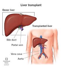 Medical illustration of liver transplant: donor liver with bile duct and portal vein, and transplanted liver position in the torso