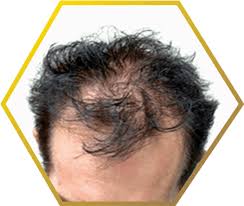 That means if other men in your family have had hair loss, you are more likely to as well. Male Pattern Baldness Hair Loss Causes Treatment