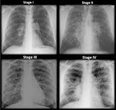 After some conversations and research i now know sarcoidosis can be mistaken for cancer. Clinical Manifestations Of Sarcoidosis Intechopen