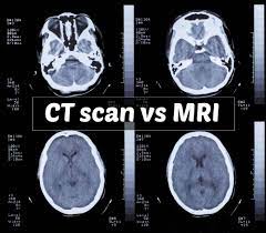Image slices that ct scans produce can. Mri And Ct Scan Comparison And Their Roles In Personal Injury Cases