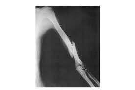 Spiral fracture femur (there is a significantly displaced spiral fracture of the proximal femoral. Radiographic Image Of A Spiral Fracture In Humerus Shaft Download Scientific Diagram