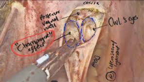 With the aid of laparoscopy, following subperitoneal dissections, reconstructive surgery of the pelvic floor. Laparoscopic Surgical Anatomy For Pelvic Floor Surgery Sciencedirect
