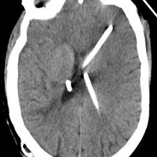 Pdf Ventriculo Ureteral Shunt Insertion Using Percutaneous Nephrostomy A Novel Minimally Invasive Option In A Patient With Chronic Hydrocephalus Complicated By Multiple Distal Ventriculoperitoneal Shunt Failures