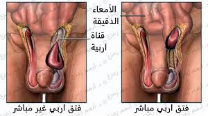 ريشة بلاط بعض الأحيان الفتق عند الرجال بالصور dsvdedommel com