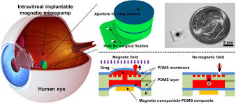 Join facebook to connect with lenus pro and others you may know. Implantable Drug Delivery Devices Sciencedirect
