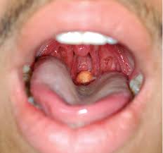 How is stage 3 throat cancer treated? A Progressively Worsening Sore Throat And Cough Consultant360