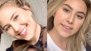 Learn how botox is used to treat tmj muscle pain. Montana Morris Using Botox To Treat Her Tmj Left Smile Botched