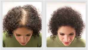 L'alopécie androgénétique est la forme la plus répandue de perte de cheveux chez les femmes. Alopecie Femme Nicolas Klein