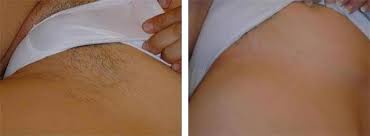 Check spelling or type a new query. Depilacion Laser En La Zona De Ingles Depilbelle