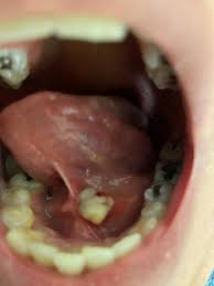 Image result for Sialolithiasis