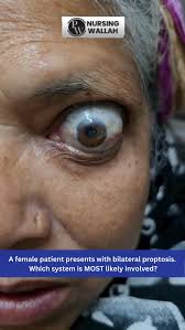 Image result for Proptosis