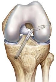 Symptoms of peroneal tendonitis/tendinopathy include: Kreuzbandersatzplastik Kniezentrum Im Medcenter 360 Berlin
