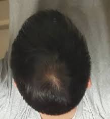 It requires absolutely straight hair, which is. 20 Year Old Asian With Thin Hair Am I Showing Symptoms Of Balding Album On Imgur