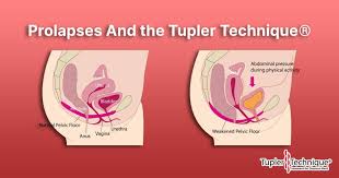Prolapses And The Tupler Technique In 2020 Pelvic Floor Physical Activities Techniques