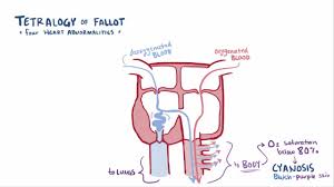 Tetralogy Of Fallot Pediatrics Merck Manuals Professional Edition