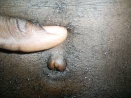 There are various techniques including: Post Op Healing Masculinity Lifes Exploration