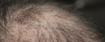 Sie analysieren dabei alle prozesse von der beratung über die eigentliche haarverpflanzung bis hin zur nachsorge. Haartransplantation In Der Turkei Mehr Lebensqualitat Mit Neuer Frisur News Wissen Gesundheit De