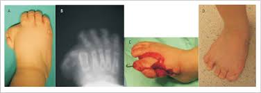 Image result for Hallux Varus