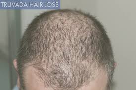 truvada hair loss why it happens and