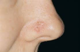The images below are some skin cancer photos. Ibd And Non Melanoma Skin Cancer Home Facebook
